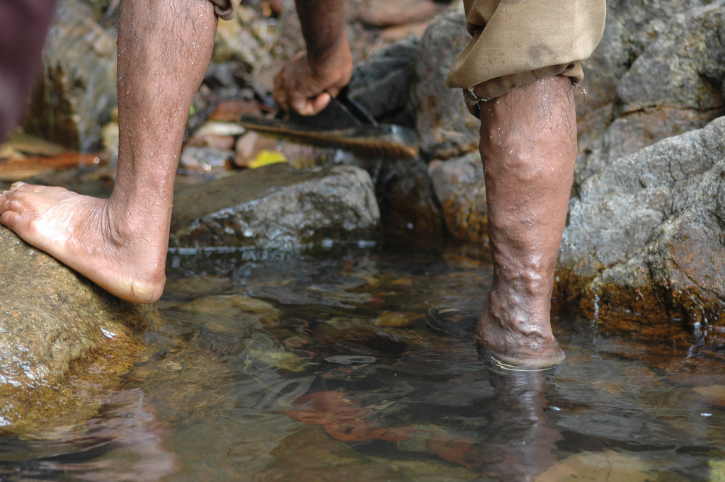 Can Varicose Veins Go Away With Home Remedies?