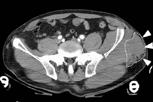 Why is Open Reduction Internal Fixation Important?