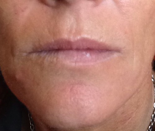 Things You Need To Know About Dermal Fillers