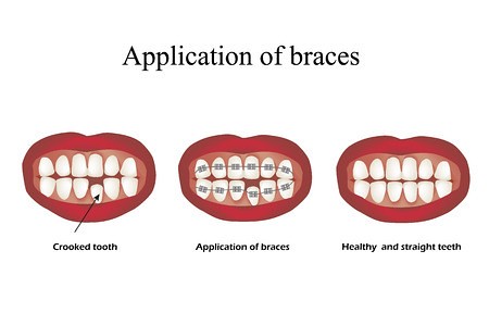 How can an Orthodontist help fix a Gummy Smile?